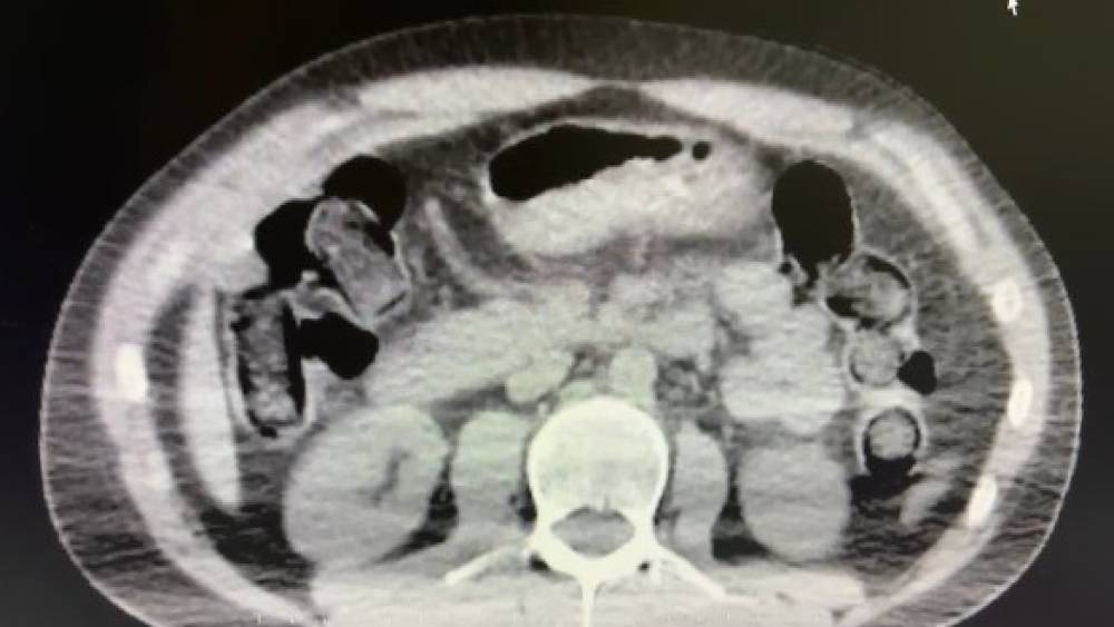 Midelerinde uyuşturucu sevkiyatı yapan 2 torbacı tutuklandı
