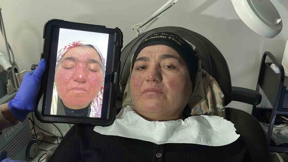 Hastalığı y&uuml;z&uuml;nden yıllarca evden &ccedil;ıkamadı, şimdi ise &ccedil;ekinmeden &ccedil;ıkabiliyor
